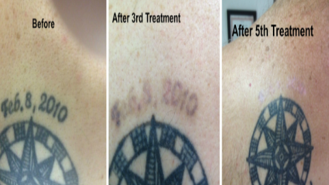 East Coast Laser Tattoo Removal