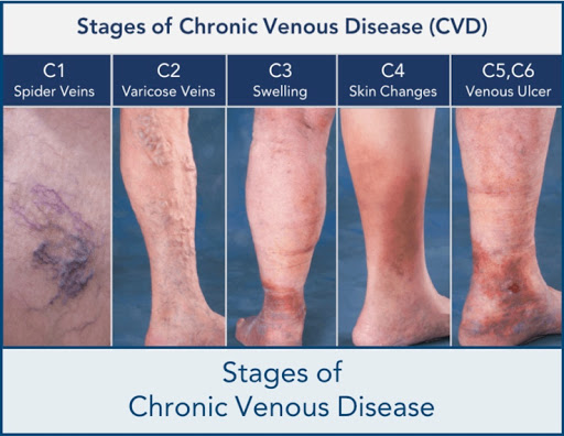 Clinicas varices Dallas