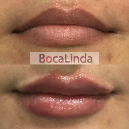 BocaLinda estetica orofacial - Machalí
