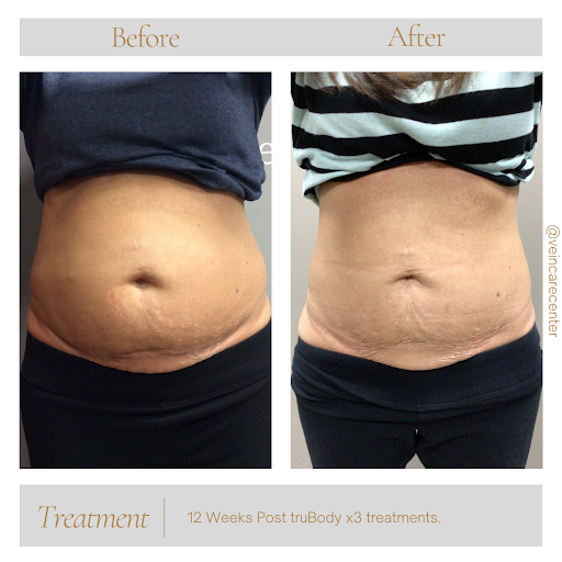 Explore cute ghost tattoo ideas, creative tattoo ideas in Lima, available at Vein Care Center Laser Specialists