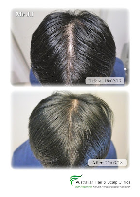 Australian Hair and Scalp Clinic (Aushair) - Australian Hair and Scalp Clinic (Aushair)