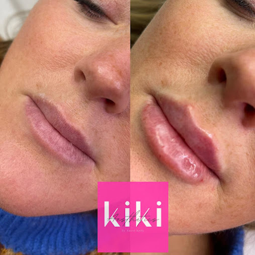 Kiss Aesthetics - Merthyr Tydfil - Kiss Aesthetics - Merthyr Tydfil