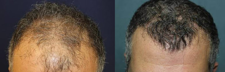 California Hair, MD: Orange County Hair Restoration