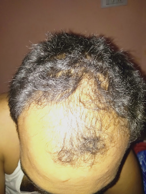 عيادة دلهي للشعر - باتيندا - Delhi Hair Clinic - Batinda