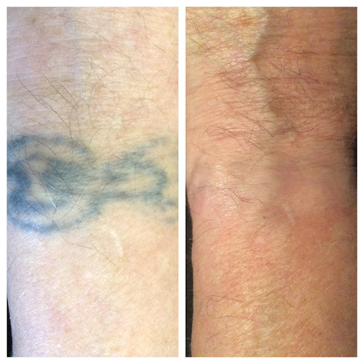 Explore one piece tattoo idea, creative tattoo ideas in Lawrence, available at Removery Tattoo Removal & Fading