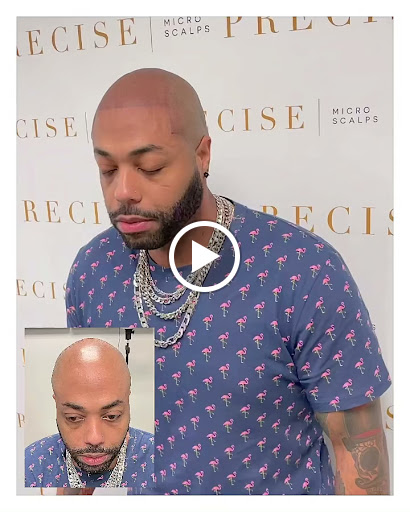 Precise Scalp Micro - Scalp Micropigmentation Service and Training image