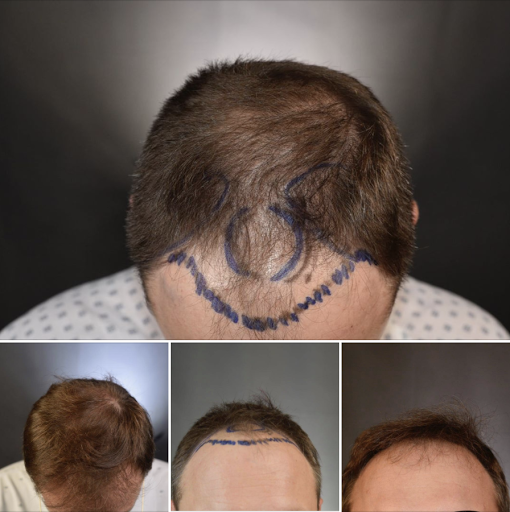 Arocha Hair Restoration