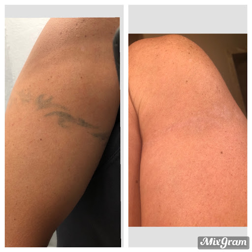 Explore cover up tattoo ideas for men, creative tattoo ideas in Tyler, available at Vanish Laser Aesthetics