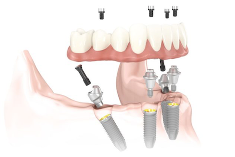 Active Dental Denture Clinic - Warrington