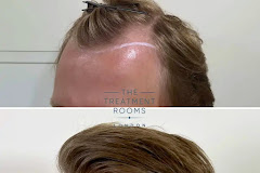 The Treatment Rooms London- Hair Transplant Clinic