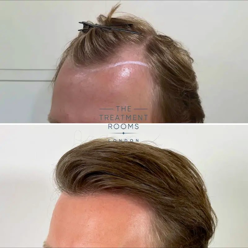 The Treatment Rooms London- Hair Transplant Clinic