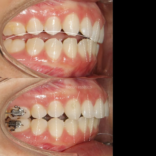 Implantes dentales en Tijuana - DENTOK México