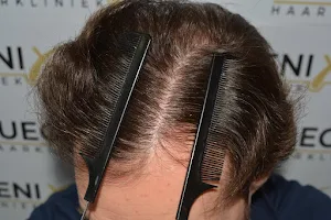FueGenix Haarkliniek | Haartransplantatie in Nederland image