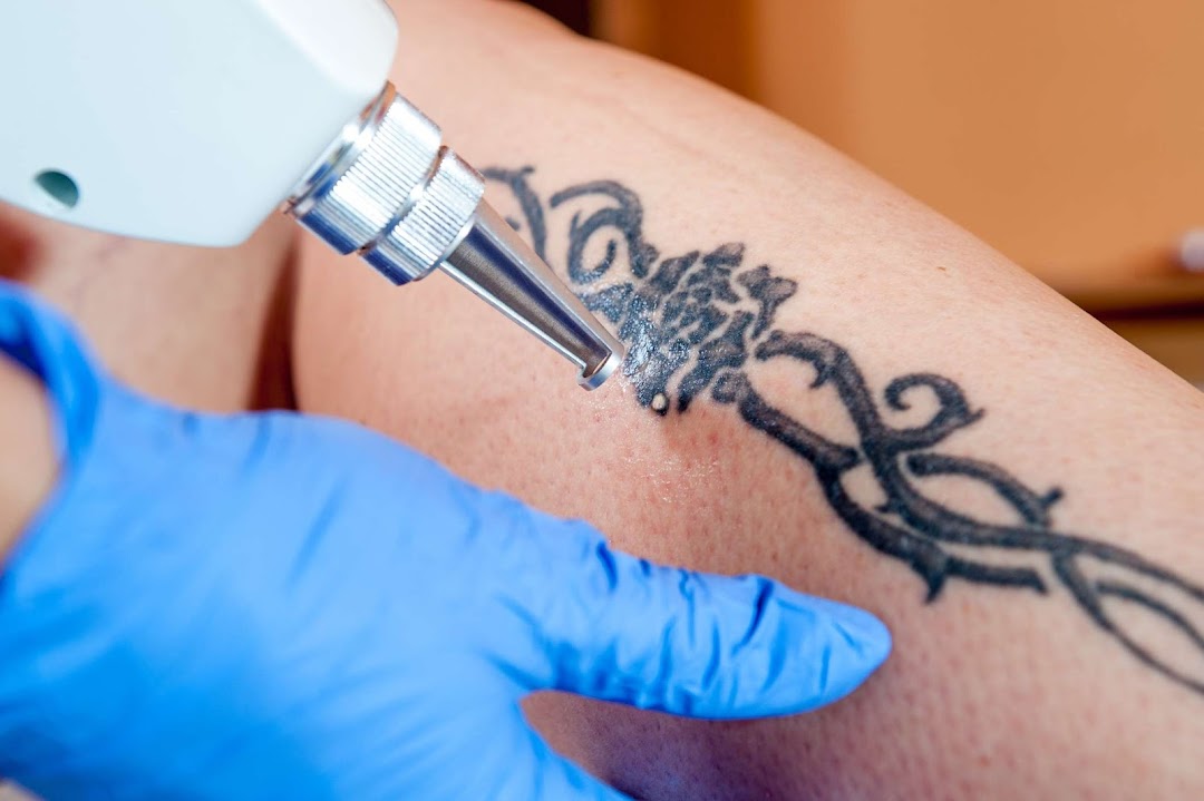 Laser Tattoo Removal NYC