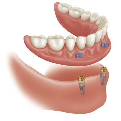 Brampton Denture & Implant Clinic