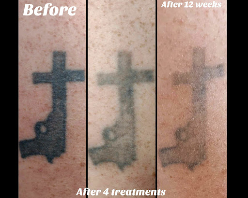 Explore ring finger tattoo ideas, creative tattoo ideas in Brighton, available at Tip of the Spear Laser Esthetics