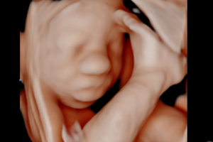 Bub-Scan 3D/4D Ultrasound image