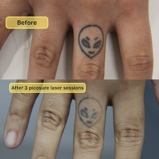 Explore dabi tattoo ideas, creative tattoo ideas in New York, available at Ag2g Laser Tattoo Removal & MedSpa