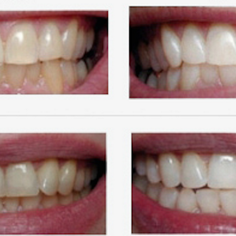 White Smile Clinic - Teeth Whitening Limerick €99