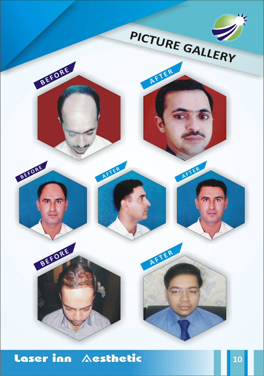 Laser inn aesthetics surgery centre skin clinic Hyderabad.