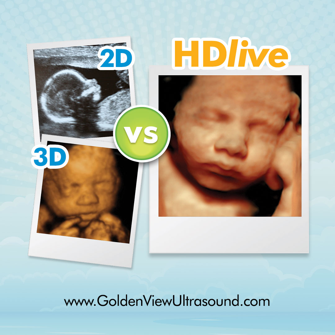 Goldenview Ultrasound 3d4dHD Boston MA