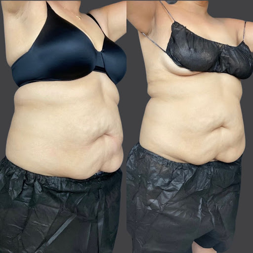 Explore exercise tattoo ideas, creative tattoo ideas in Whittier, available at Skin Perfect Medical Aesthetics