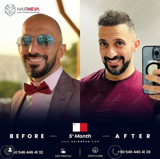 مركز زراعة الشعر Serap Perk - Serap Perk Hair Transplantation Center