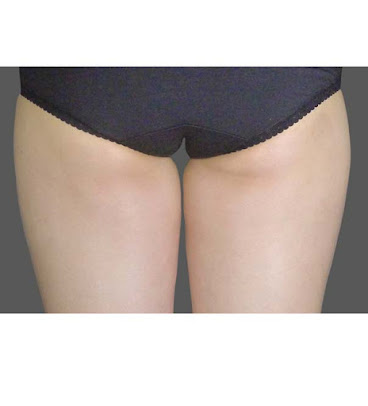 Bucks Cavitation - Bucks Cavitation