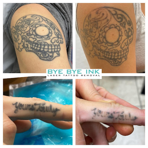 Find top of head tattoo ideas for your next unique tattoo in Middle Village at Bye Bye Ink Laser Tattoo Removal