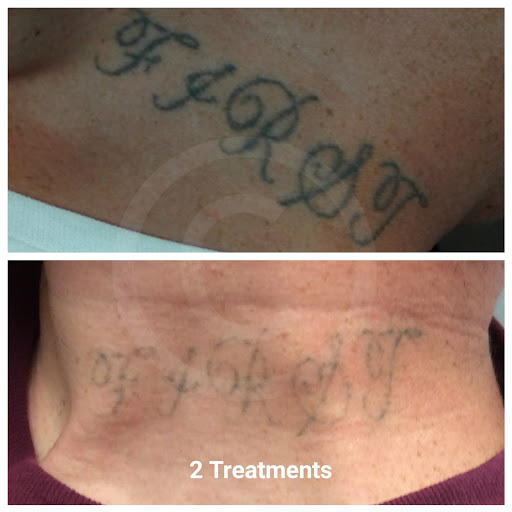 Explore medic alert tattoo ideas, creative tattoo ideas in Louisville, available at Removery Tattoo Removal & Fading