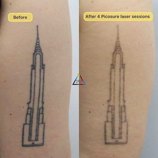 Explore house of the dragon tattoo ideas, creative tattoo ideas in New York, available at Ag2g Laser Tattoo Removal & MedSpa