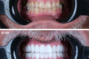 Smile Team Turkey - (Dental Implants, Crowns, Veneers & Teeth Whitening) image