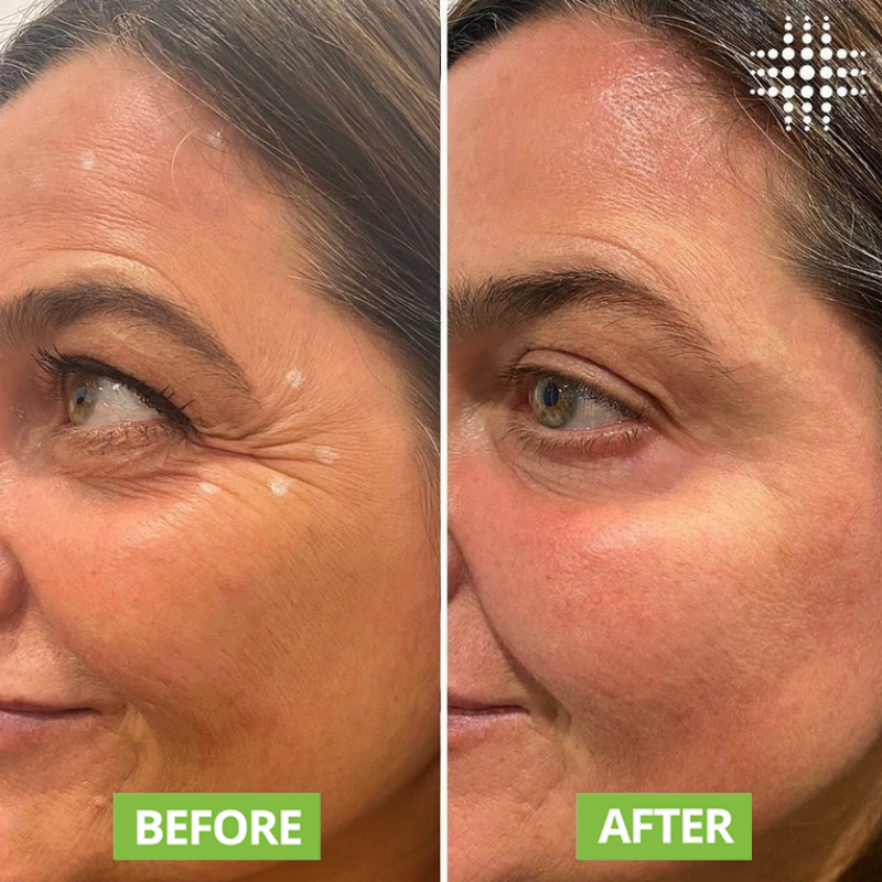 Results Laser Clinic - Wollongong