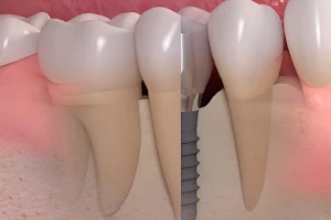 Zahnarztpraxis München - Zahnprothesen - Implantat Praxis - Ästhetische Zahnheilkunde - Weisheitszähne - 3D-Röntgen (DVT) image
