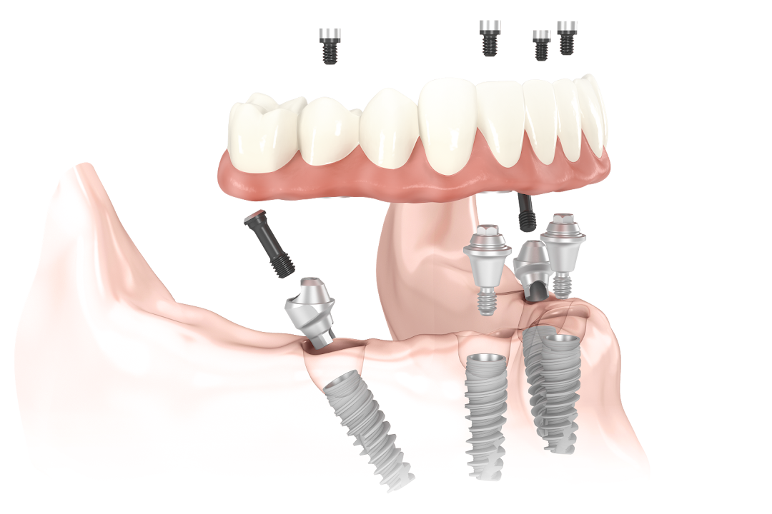 Kansas City Dental Implant Center