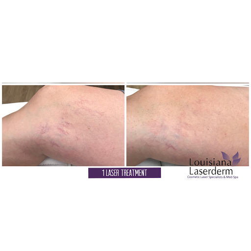 Explore california tattoo ideas small, creative tattoo ideas in Baton Rouge, available at Louisiana Laserderm