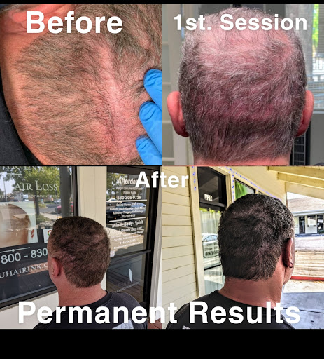 Explore vegeta and bulma tattoo ideas, creative tattoo ideas in Roseville, available at NuHair Ink. Scalp MicroPigmentation & Aesthetic Clinic of Sacramento