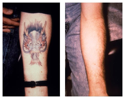 Explore arm tattoo ideas women, creative tattoo ideas in Colleyville, available at DFW Tattoo Removal