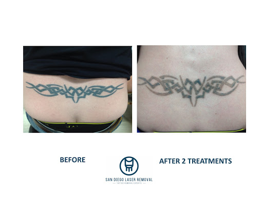 Explore fox and the hound tattoo ideas, creative tattoo ideas in San Diego, available at Removery Tattoo Removal & Fading