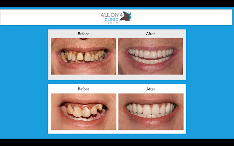 All On 4 Clinic Perth - All On 4 Clinic Perth