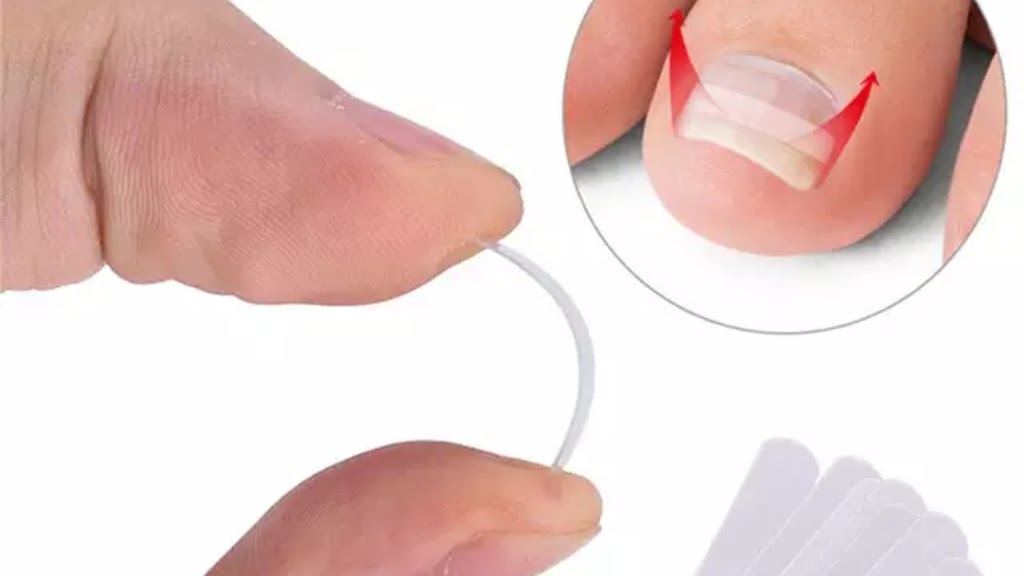 Ingrown Toenail Repair Bradenton, FL 34209 Services and Reviews