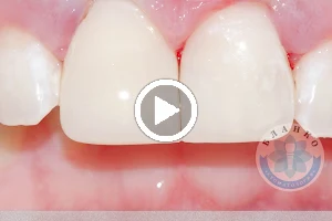 Стоматология «Blanco» — Днепр | Лечение Зубов Под Микроскопом | Имплантация зубов | Протезирование зубов | Оплата частями ( кредит на лечение, рассрочка от ПриватБанка ) | Гарантия image