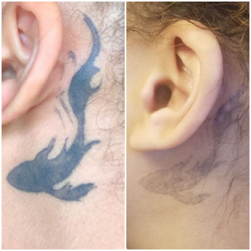 Explore mickey mouse tattoo ideas, creative tattoo ideas in Houston, available at Htown Lasers