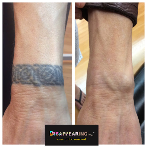 Explore tattoo ideas dolphin, creative tattoo ideas in Lawrence, available at Removery Tattoo Removal & Fading