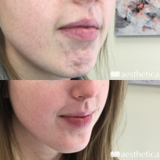 Explore 3 heart tattoo ideas, creative tattoo ideas in Pleasant Grove, available at Aesthetica