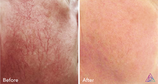 Explore dragonfly tattoo ideas for females, creative tattoo ideas in Glenwood Springs, available at Lifestyle Laser