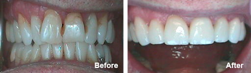 Teeth whitening service Huntington Beach