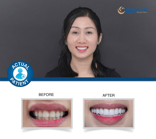 Dental whitening Hanoi