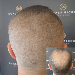 Scalp Micro Scotland - Scalp Micropigmentation