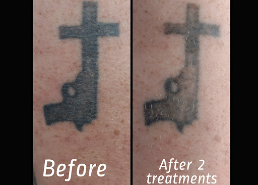 Explore tattoo ideas for doctors, creative tattoo ideas in Brighton, available at Tip of the Spear Laser Esthetics